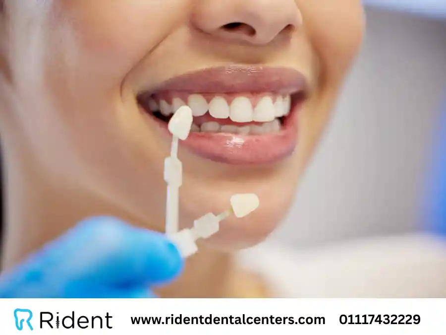 تجربتي مع الفينير في مصر 2025